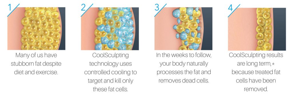 how-coolsculpting-works-citydermlaser